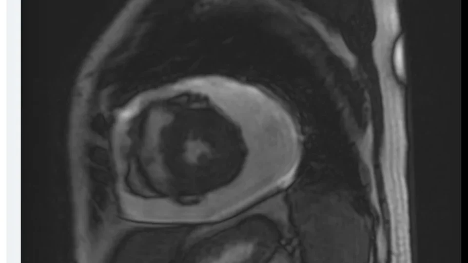 Imagem de ressonância magnética cardíaca ao lado do módulo segmentar de fibrose do EcoPylot.